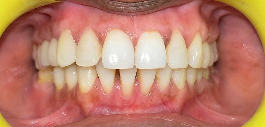 Gum Treatments After