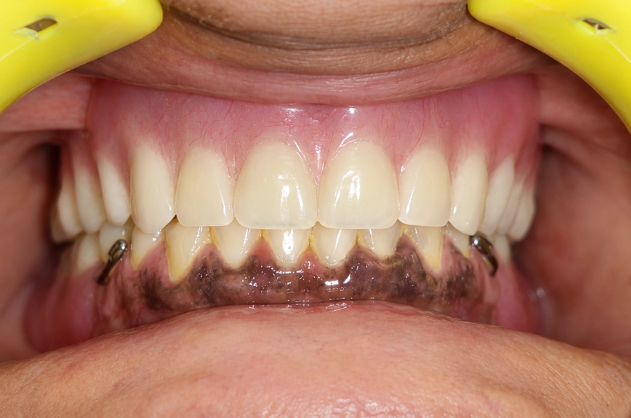 Dental Crowns & Bridges After