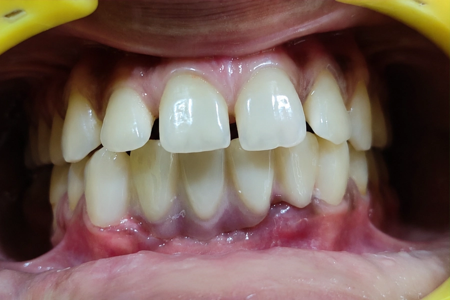 Dental Crowns & Bridges After