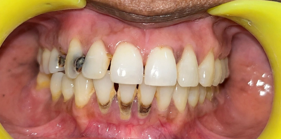 Gum Treatments Before