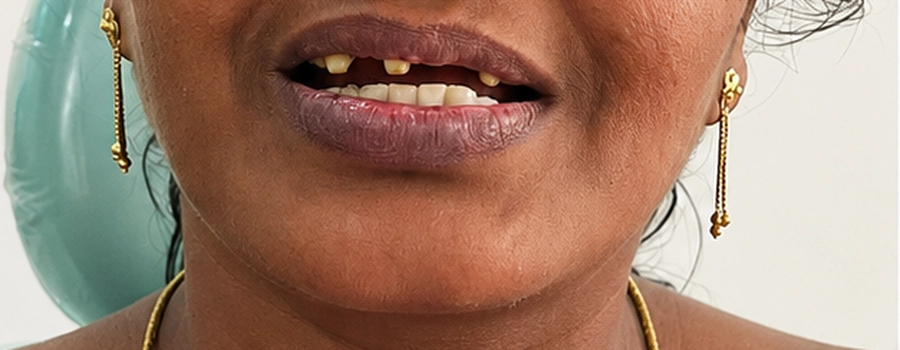 Smile Designing Before