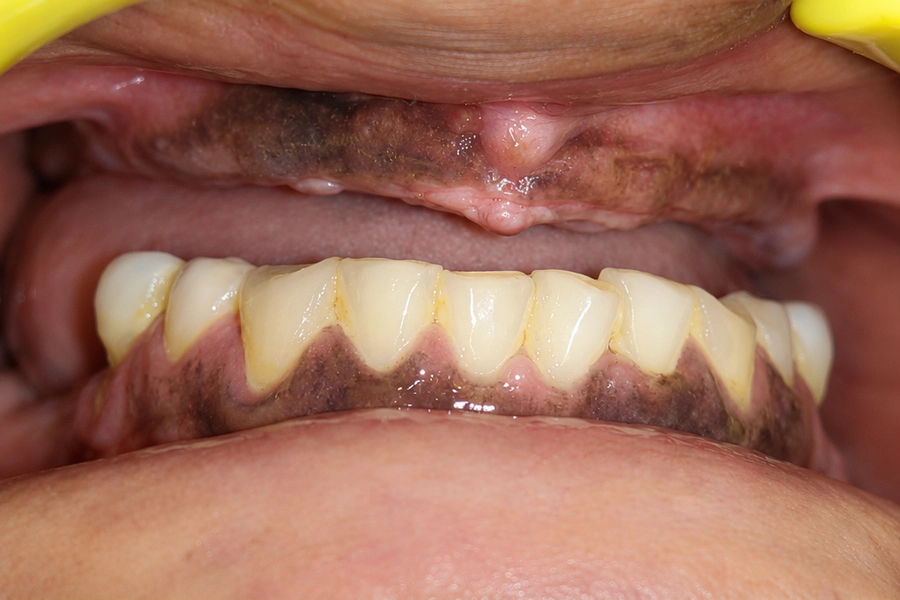 Dental Crowns & Bridges Before