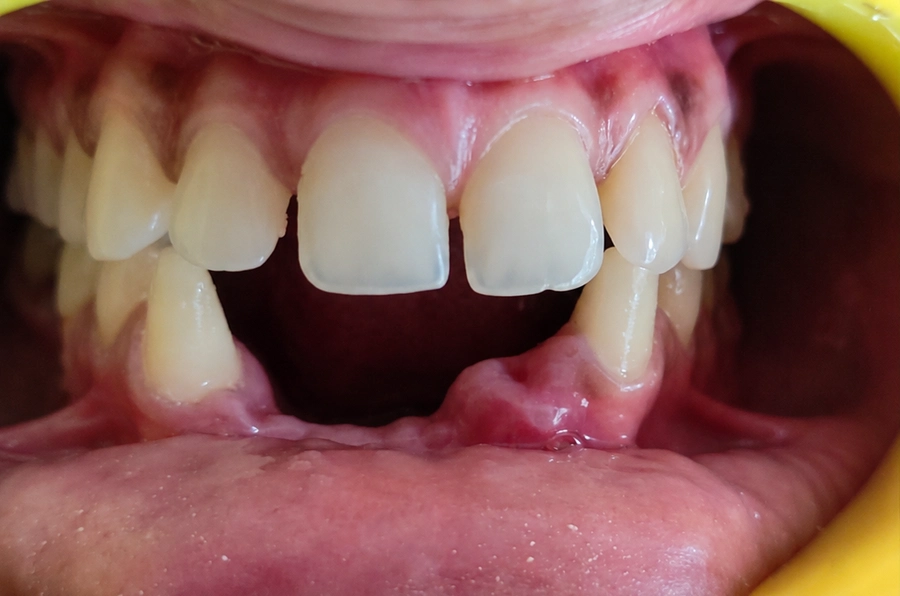 Dental Crowns & Bridges Before