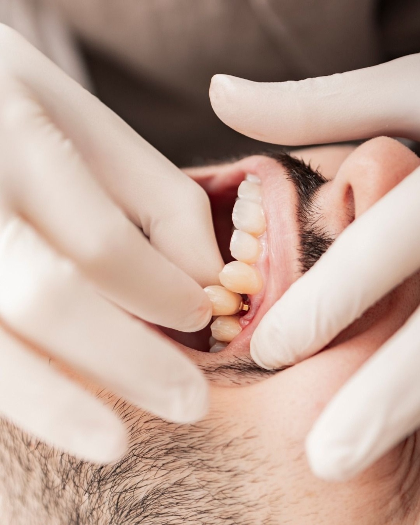 A Complete Guide to Dental Implants: Procedure & Recovery