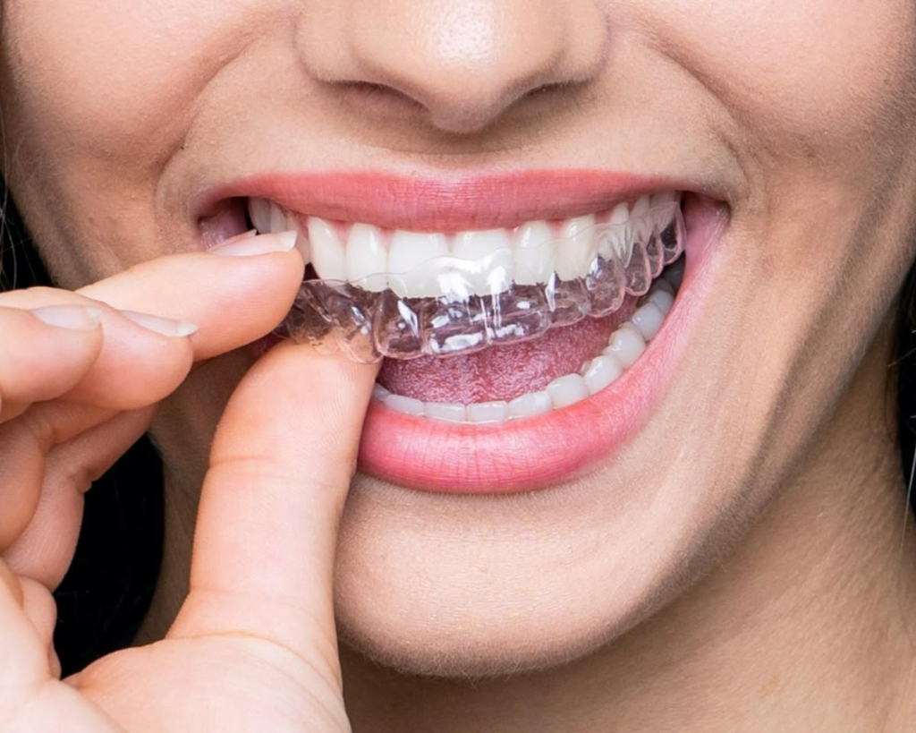 Braces & Aligners Banner