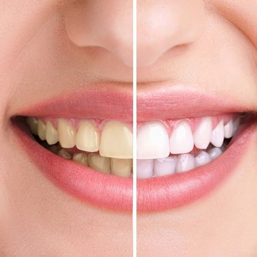 Teeth Whitening Banner