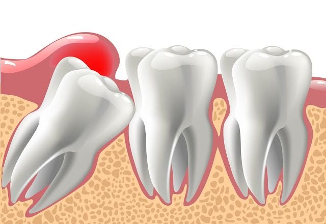 Wisdom Tooth Removal Banner